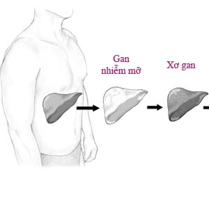 Đông y chữa gan nhiễm mỡ