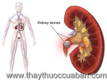Chữa khỏi bệnh sỏi thận