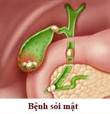 Bệnh sỏi mật, đ�ng y chữa bệnh sỏi mật