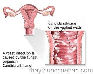 Nhiễm nấm âm đạo, Đông y điều trị nhiễm nấm âm đạo