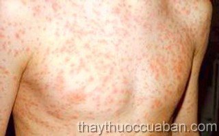 Phát ban đỏ, Đông y chữa phát ban đỏ, phat ban do, dong y chua phat ban do