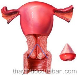 Phì đại tử cung, Đông y điều trị phì đại tử cung, phi dai tu cung, Chua khoi phi dai tu cung