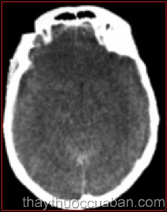 Phù não, Đông y chữa bệnh phù não, phu nao, dong y chua phu nao
