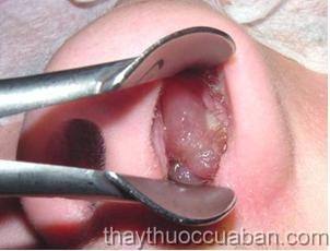 Polyp mũi, Đông y chữa polyp mũi, chua polyp mũi