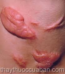 Đông y điều trị sẹo lồi