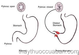 Đông y điều trị tắc môn vị