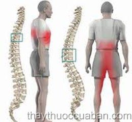 Tăng sinh cột sống