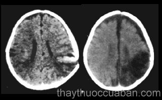 Đông y điều trị teo não