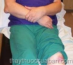 Đông y chữa bệnh thống phong