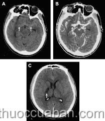 Tràn dịch màng não