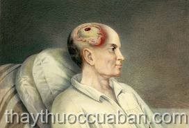 Tụ máu nội sọ