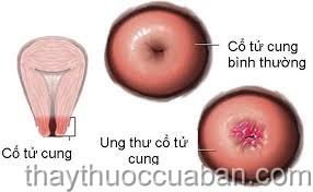 Ung thư cổ tử cung