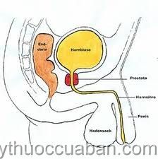 Ung thư tiền liệt tuyến