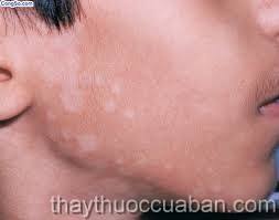 Đông y điều trị vết loang trên da