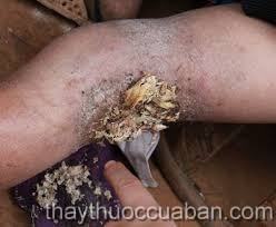 Vết thương lâu ngày