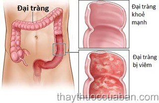 Viêm đại tràng co thắt