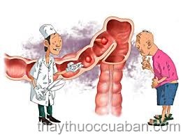 Viêm đại tràng mãn