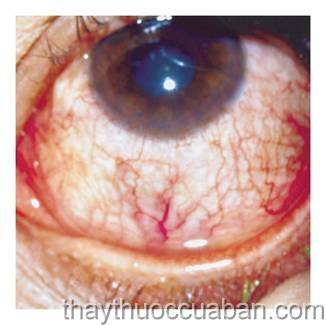 Xuất huyết đáy mắt