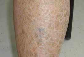 Đông y chữa bệnh da cá