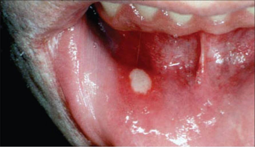 Áp tơ miệng, ap to mieng, aptomieng