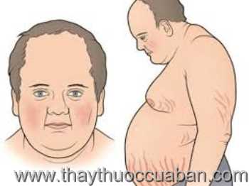 Bệnh Cushing