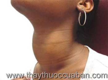 Chữa bệnh bướu cổ