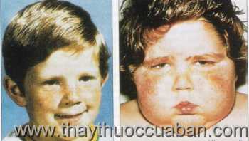 Chữa bệnh Cushing