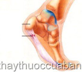 Bệnh đau gót chân