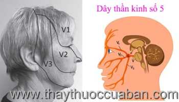 Đau thần kinh số 5