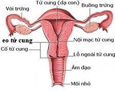 Eo tử cung, eo tu cung