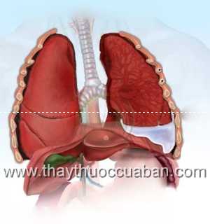 Tràn dịch màng phổi
