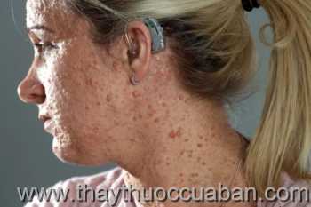 Bệnh u xơ thần kinh