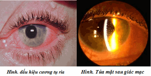 Cương tụ r&igrave;a v&agrave; tủa sau gi&aacute;c mạc